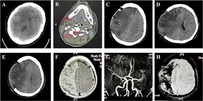 Massive Cerebral Infarction Following Facial Injection of Autologous Fat: A Case Report and Review of the Literature